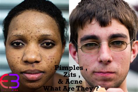 Pimples , Zits & Acne , What Are They