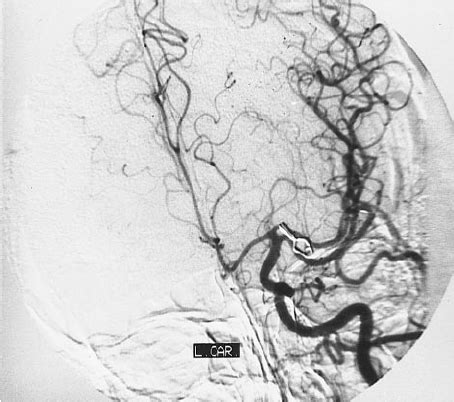 A drawing of intraoperative anatomy via left pterional craniotomy. 1 ...