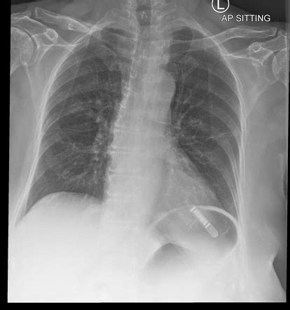 Implantable loop recorder | Radiology Case | Radiopaedia.org