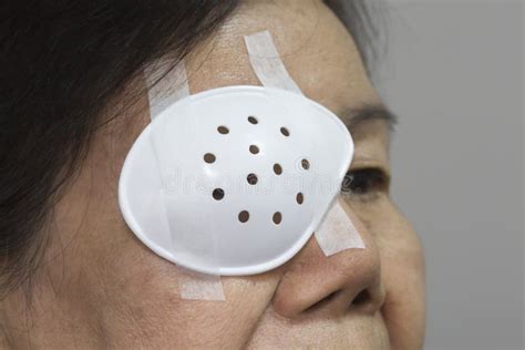 Eye Shield Covering After Cataract Surgery. Stock Photo - Image: 64537551