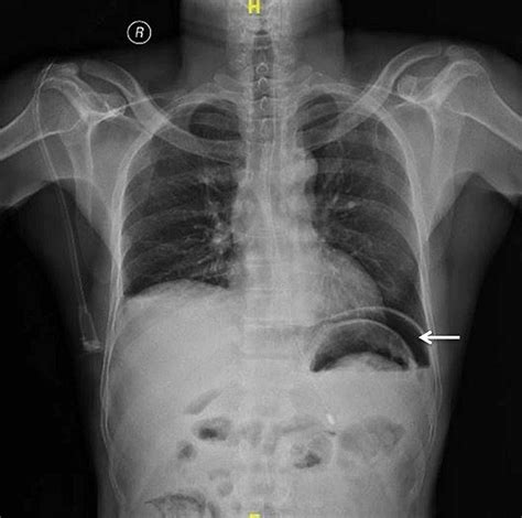 Perforation of the Meckel’s Diverticulum Following Blunt Trauma to the Abdomen | Cureus