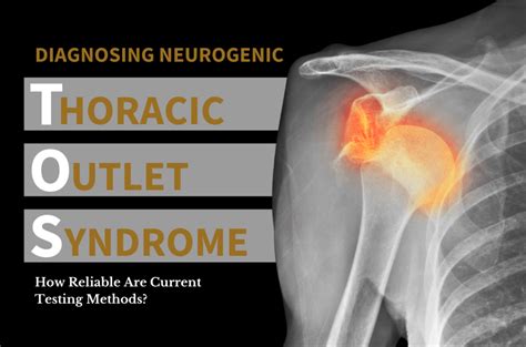 Thoracic Outlet Syndrome X Ray