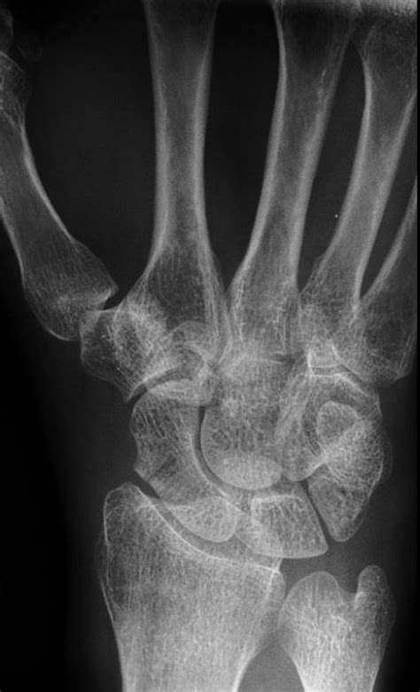 Scaphoid fracture - undisplaced | Radiology Case | Radiopaedia.org | Scaphoid fracture ...