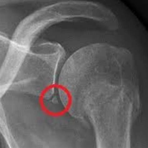 Shoulder Instability Series (Part 1): Dislocations, Labral Tears and the Bankart Lesion | POGO ...