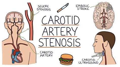 Understanding Carotid Artery Stenosis - YouTube