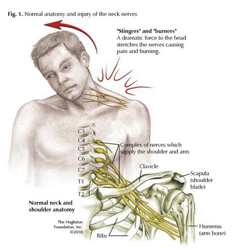 Brachial Plexus: Traumatic Nerve Injuries - Hughston Clinic