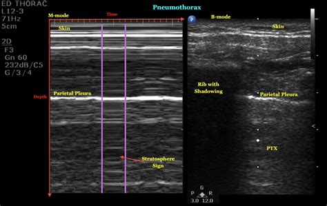 M-Mode for Pneumothorax | Emory School of Medicine