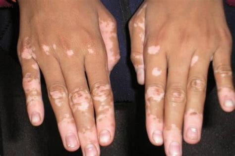 Vitiligo: Causes, Symptoms and Treatments – From Doctor