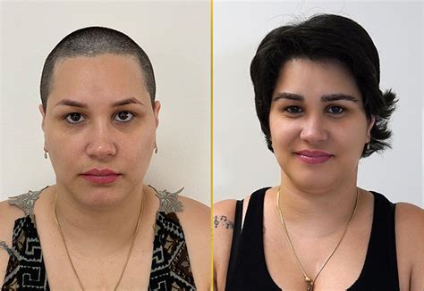 Female Hair Transplant in Miami | Care4Hair