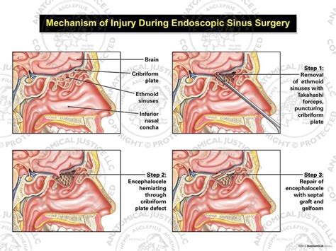 Mechanism of Injury During Endoscopic Sinus Surgery