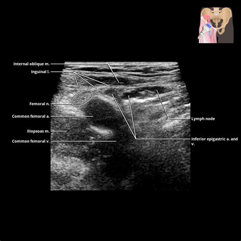 Groin | Radiology Key