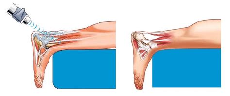 Shock Wave Therapy For Heel Pain Reviews