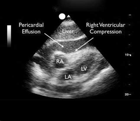 Cardiac Tamponade: Early Diagnosis with Echocardiography