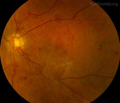 Proliferative diabetic retinopathy (PDR)