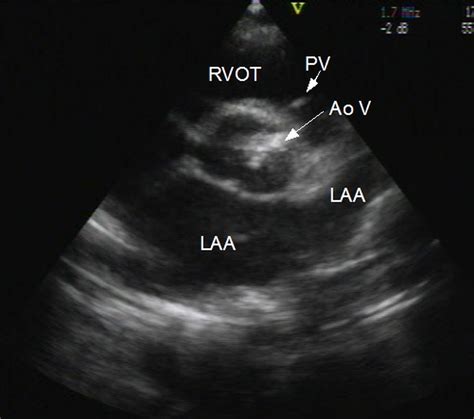 Aortic stenosis: Echocardiogram in parasternal short axis view – All ...