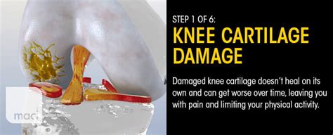 MACI Knee Cartilage Regeneration in Baton Rouge, LA