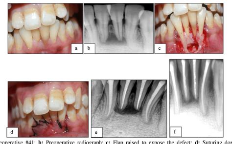 Figure 2 from Apicoectomy: An elucidation to a hitch | Semantic Scholar