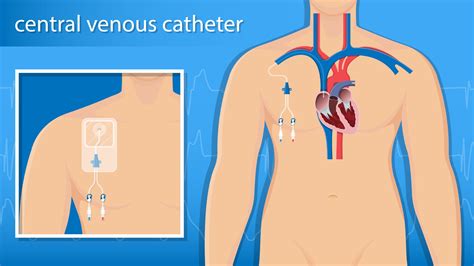 What are the types of Central Venous Catheters? | Vascular Wellness