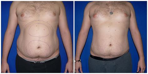 Patient #276 Male Liposuction Before and After Photos Katy - Plastic ...