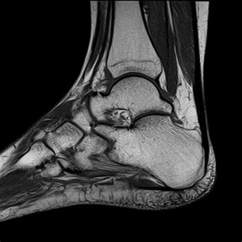 Ankle MRI | Elite MRI of Michigan