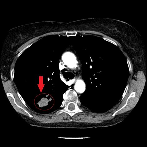 Adenocarcinoma of the lung CT - wikidoc