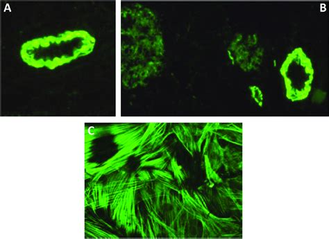 Anti-smooth-muscle antibodies. Immunofluorescence pattern of smooth ...