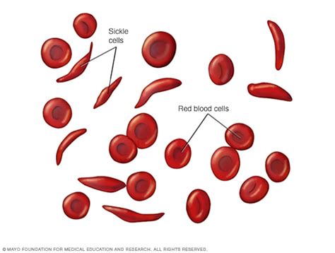 Sickle cell anemia - Symptoms & causes - Mayo Clinic