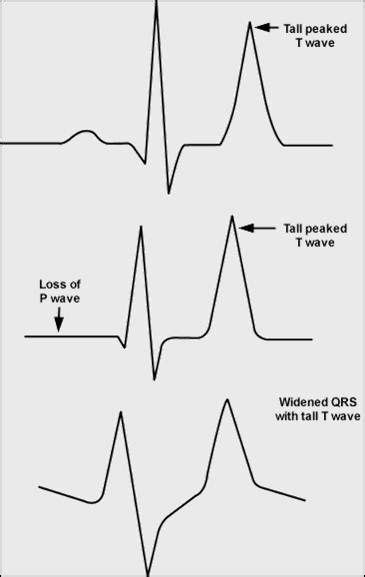 The EKG below demonstrates Peaked T waves of hyperkalemia . | Hyperkalemia, Emergency nursing ...