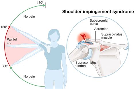 Shoulder Impingement Syndrome Causes, Treatment, & Prevention