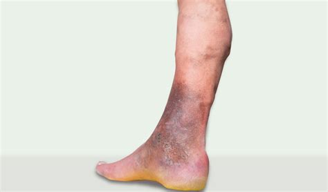 Ankle Discoloration Causes and Treatment | Vein Institute Of Pinellas