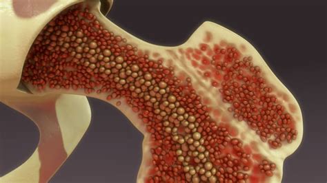 Bone Marrow Cancer types and treatment - Oncoplus Hospital