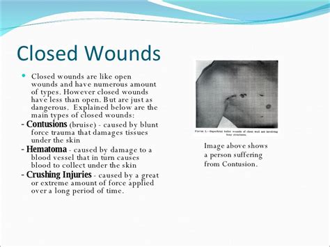 Wounds