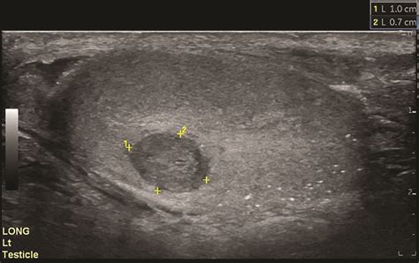 Bilateral Germ Cell Neoplasia In Situ with Left Testicular Seminom ...