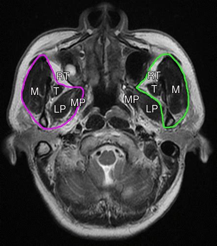 Prognostic Value of Grading Masticator Space Involvement in ...