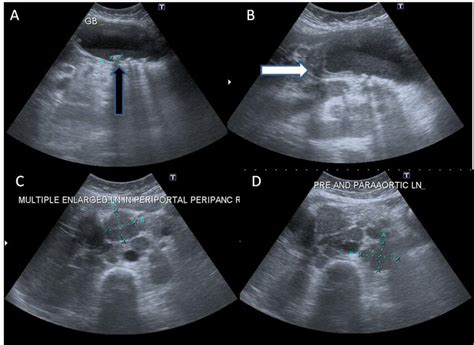 (A-D)In a known case of cholelithiasis, ultrasound images reveal ...