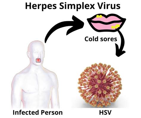 Herpes Simplex Virus: Types, Causes, and Treatment