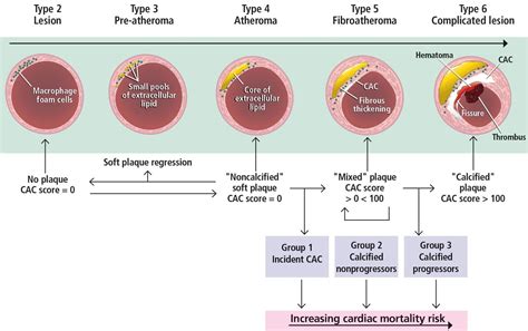 Coronary artery calcium scoring: Its practicality and clinical utility ...