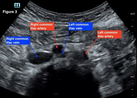 May Thurner. Transverse ultrasound of the abdomen using a curvilinear probe with the indicator ...