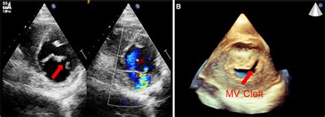 Anomalous Origin of Left Coronary Artery From the Pulmonary Artery and ...