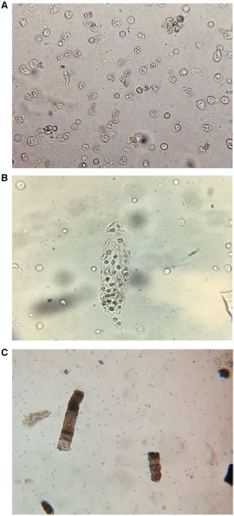 Wbc Casts In Urine