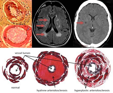 FAZEKAS scale | STROKE MANUAL