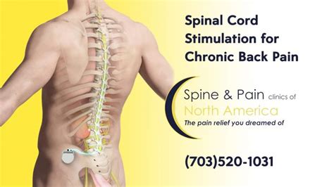 Spinal Cord Stimulation. SAPNA: Spine and Pain Clinic of North America ...