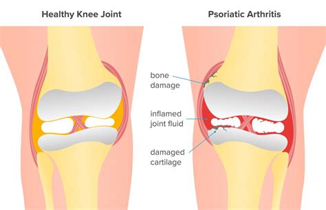 Psoriatic arthritis of the knee: Symptoms and treatment