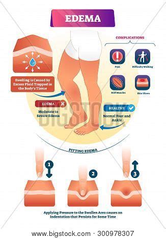 Edema Vector Illustration. Labeled Interstitium Fluid Accumulation ...