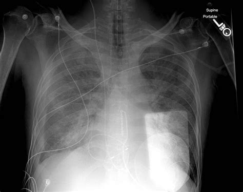 Transvenous Cardiac Pacing Pitfalls | Resus Review