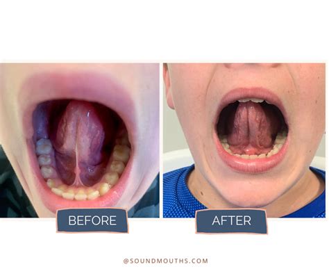 Pre and Post Frenectomy Therapy - Sound Mouths