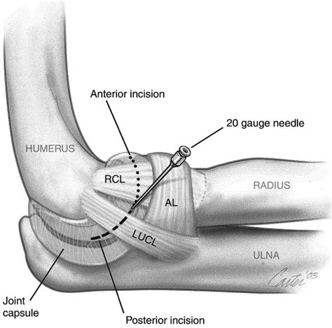 The effect of arthroscopic sectioning of the lateral ligament complex ...