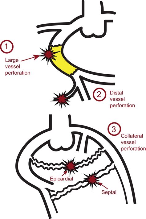 Perforation | Thoracic Key