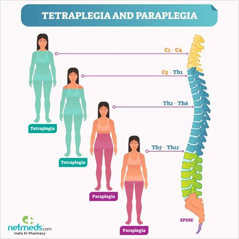 Paraplegia: Causes, Symptoms And Treatment | Netmeds