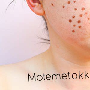 What is Mottling of the Skin? Causes, Symptoms and Treatment - The Knowledge Hub